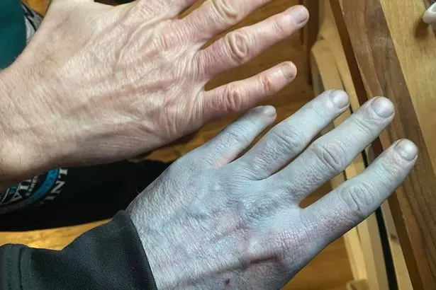 'I was rushed to hospital after waking up blue - doctors couldn't stop staring at me'