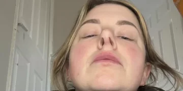 Mum ‘devastated’ after nose job says ‘I’ll never go to Turkey again’